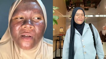 Nur Lenny Astia Ungkap Perjuangan Bebaskan Wajah dari Jerat Merkuri Ilegal